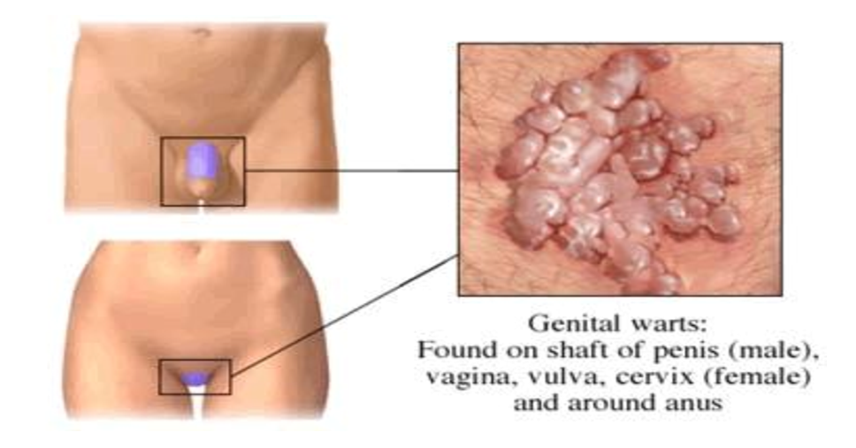 View Hpv Bumps On Penile Shaft Treatment Pictures