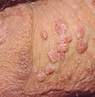 mild hpv male